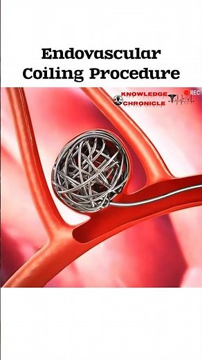 Endovascular Coiling Procedure: A Life-Saving Treatment for Brain Aneurysms #shorts #trending #reels