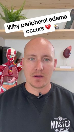 Understanding Peripheral Edema: Causes and Symptoms