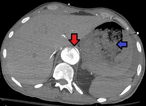 Aortoenteric fistula - Alchetron, The Free Social Encyclopedia