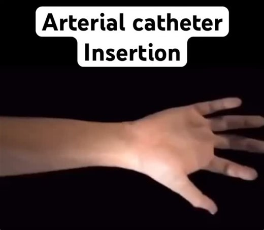 medico on Instagram: "Arterial catheterization is a medical procedure to insert a thin tube (catheter) into an artery (like the radial or femoral) for precise, continuous blood pressure monitoring, frequent blood gas analysis (oxygen/CO2 levels), and easier blood draws in critically ill patients, often in ICUs or operating rooms, providing real-time data for critical care management. This "art line" allows for highly accurate hemodynamic assessment, especially vital during surgery or respiratory