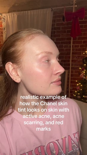 Realistic Chanel Skin Tint on Acne Prone Skin