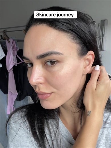 Sharni's Skin Journey: Healing Congestion, Acne, and Dermatitis