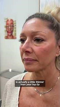 Juvederm Lips Consult pt 3: Technique