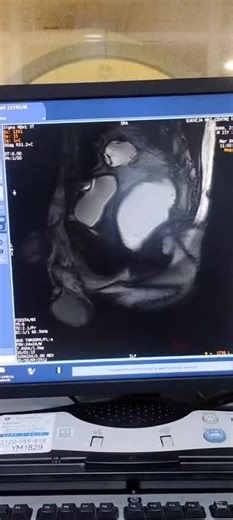 MRI DefecographyMRI Defecography is a specialized imaging test used to assess pelvic floor function and diagnose disorders affecting bowel movements. It provides detailed images of the rectum… | Manoj gill