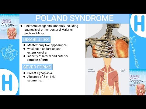 Poland Syndrome-Upper limb clinicals(brief explanation)
