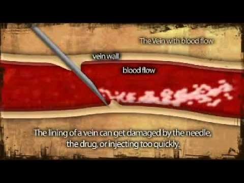 AIVL Vein Care Guide Vein Collapse Animation