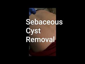 Sebaceous Cyst Removal