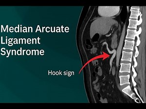 Laparoscopic Median Arcuate Ligament Release- Dr Pinky Thapar