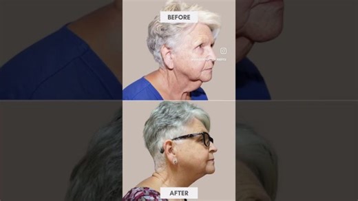 Dr Shah explains about a Neck lift and the best way to do it. | Himansu Shah