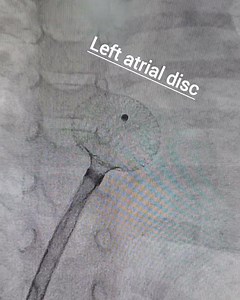 ASD DEVICE CLOSURE DONE ( Cath Lab)