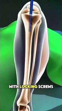 Tibia fracture surgery 3d Animation