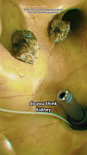 Percutaneous nephrolithotomy (PCNL) (3D Animation)