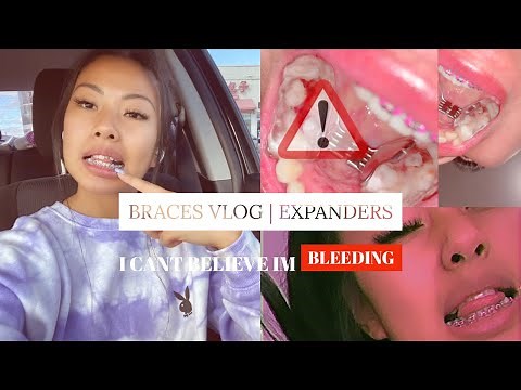 Getting Braces VLOG 2 | Hyrax Expanders Q&A
