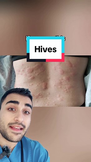#medicine #medical #allergies #allergicreaction #medicaltiktok | Hives