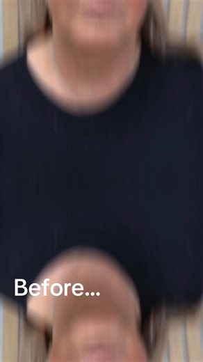 Amazing before and after of our ‘Ultimate Facelift Package’! Includes PDO Cog Threads & Dermal Filler! Book a free consultation today! #aesthetics #fillers #dermalfiller #clinic #AestheticsClinic #beauty | HAUS OF REJUVENATION