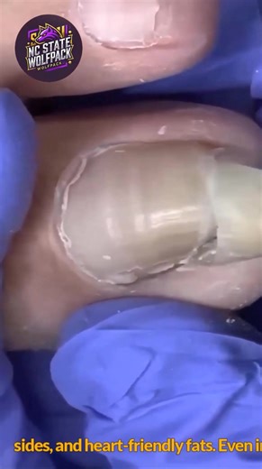 Thickened toenails: safe routines to ease swelling 💖 #WellnessSeniors #EverydayCare #SafeSteps | NC State Wolfpack on TheWolfpacker.com