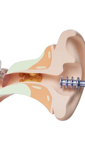 Effective Earwax Removal Techniques to Try Today