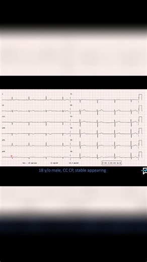 Practical EMS | Slow heart rate? Looks like sinus bradycardia. P wave before every QRS complex. Rhythm looks regular. #SinusBradycardia #HeartRate #EKG... | Instagram