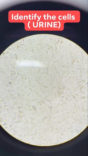 Identify the cells under microscope 🔬🔬 #spotlight2024 #medical #facts #laboratorytesting #diagnostics #labtests #viralshorts #diagnosticterminology #wellness #viralpost #viralvideoシ #viralpost2024 #viralreelsfacebook | Progressive Medical Laboratory Technology