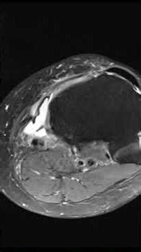 Posteromedial Knee Pain: Bursitis Explained#msk #radiology#mri#knee#pain#trauma#athlete #anatomy