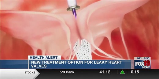New treatment option for leaky heart valves