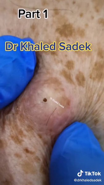 Dr Khaled Sadek: Pimple Popping, Blackheads & Cyst Removal