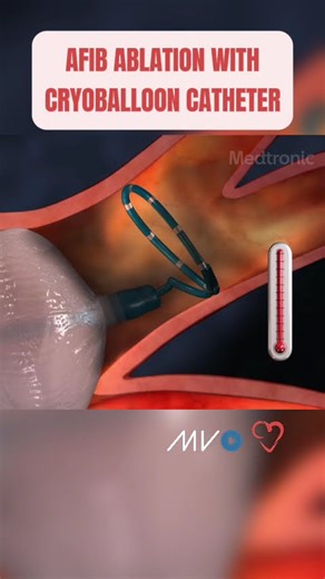 Cryoballoon Catheter Ablation❄️🫀