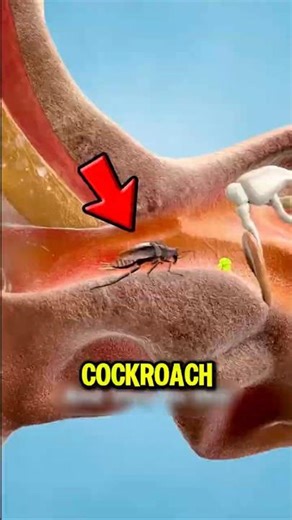 Cockroach Inside Ear? Do This Fast!😱