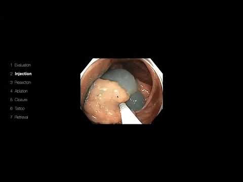 Zoom Class - Endoscopy Refresher - Large Colon Polyp Management