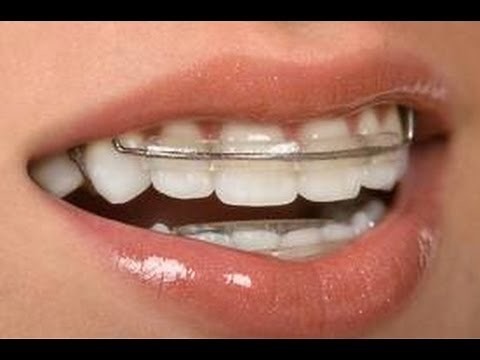 {#173}: How to put on Hawley Retainer