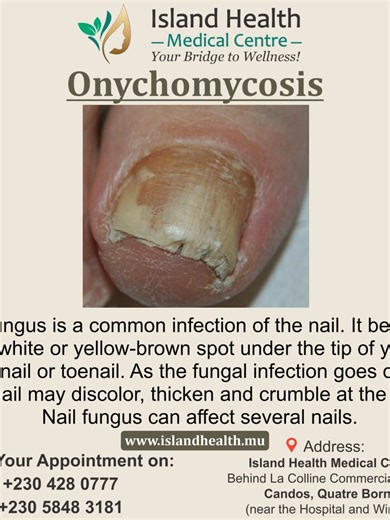 Onychomycosis Kindly call us on 4280777 or WhatsApp on 58483181 for all your queries we will be glad to assist you. Island health medical Centre offers treatment for psoriasis, eczema, acne, vitiligo, melasma, warts, keloids scars, lipomas, cyst, varicose veins, Hidradenitis Suppurativa, laser treatments, hair removal, skin tags, Genitals Warts and warts on you feet’s, cosmetics treatments. We over general medical services, chronic diseases like hypertension, diabetes etc. General checkups. Trea