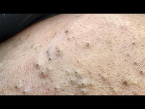 NIGHTLY BLACKHEAD REMOVAL | My At-Home Facial Routine for Clear Skin