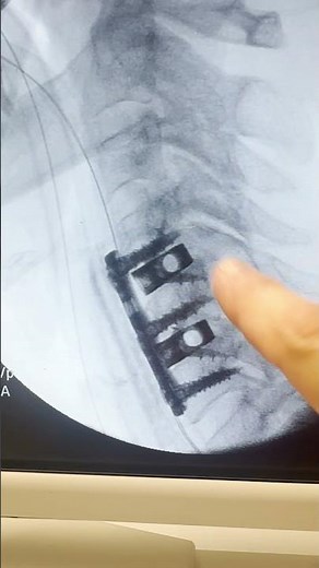 Two-Level Cervical Fusion