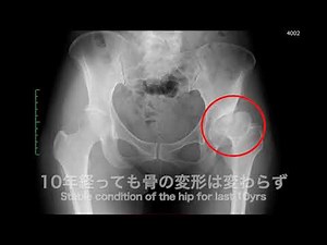 50代 変形性股関節症 進行期/末期