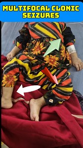 Multifocal clonic seizures #seizures #epilepsy #fits | Dr. Arshad Mehmood - Child Specialist