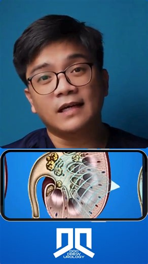 Stone recurrence #docdrew #urologist #urology #shockwave #eswl | Doc Drew Valdez - Urology