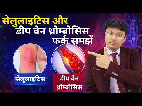 DIFFERENTIATION OF CELLULITIS FROM DEEP VENOUS THROMBOSIS