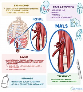 Median Arcuate Ligament Syndrome (MALS): What Is It, Causes, Symptoms | Osmosis