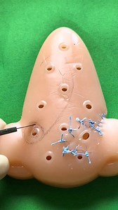 Rotation flap for nasal reconstruction (part 1) | Dermhacks