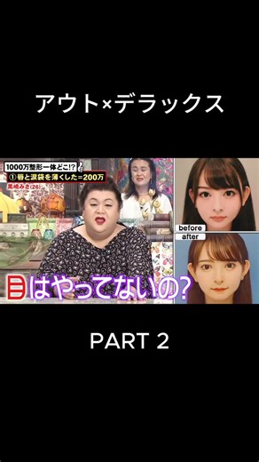 【悲報】鼻再手術を4回、鼻中隔延長、鼻ゴアテックス→プロテ入れ替え、顎骨切り、エラ削り、顎下脂肪吸引3回の4桁整形を行った黒崎みささん。ナチュラル派のマツコから『ビフォーの顔の方がバランスが良い』という辛辣な意見を喰らってしまう。。。