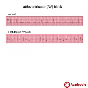 23 reactions | How to Recognize AV Block - Some Quick Tips - Find out more at https://acadoodle.com #emergencymedicine #intensivecare #respiratory #respiratorycare #icu #nurses #icunurse #ecg #ekg #cme #cmeonline | Acadoodle | Facebook