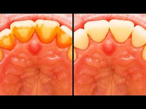 15 EASY TEETH HACKS THAT WILL CHANGE YOUR LIFE