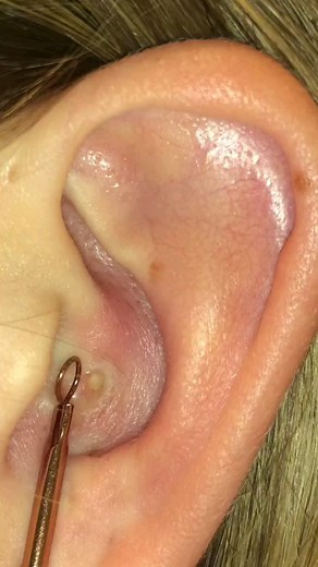 Pimple Content⚠️ on Instagram: "The end襤 . . - #pimple #pimples #pimplesremover #pimplepop #pimplelife #pimpletreatment #blackheads #blackheadextraction #blackheadremoval"