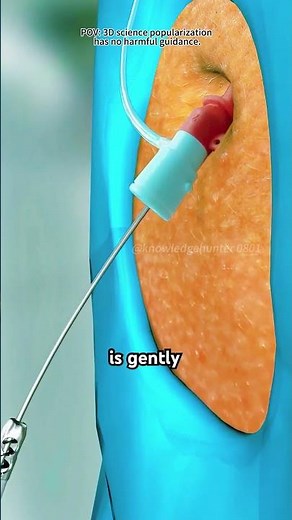 Mechanical Thrombectomy Procedure (3D Animation)