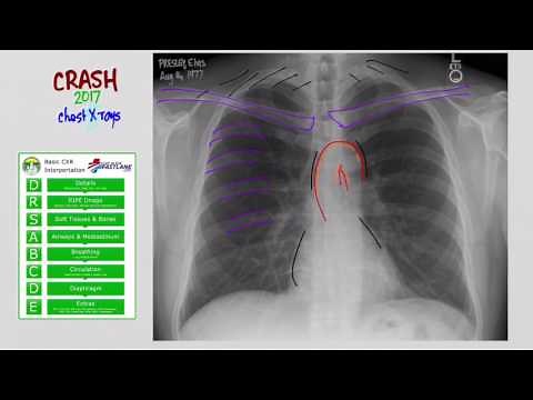 02 CXR: DRS ABCDE Method