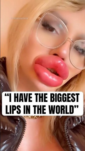 "I Have The biggest Lips In The World" #shorts #plasticsurgery #facesurgery