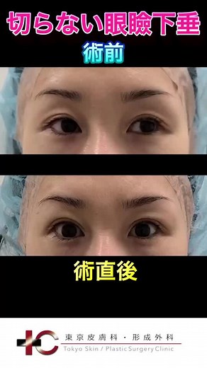 動画対応で手術直後から美を追求しています。 何をしたか分からないけど可愛くなった。が本当の美容の成功。 切らない眼瞼下垂手術は自分で二重の幅を選べます。 #切らない #切らない眼瞼下垂 #眼瞼下垂手術 #東京皮膚科 #東京皮膚科・形成外科 #ニューフェイス #ニューフェイスクリニック #東京皮膚科形成外科