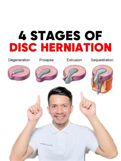 4 STAGES OF HERNIATED DISC AND HOW TO FIX THEM!! 🤩🤩🤩 | Physical Therapy Session