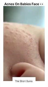 "Neonatal Acne in Newborns: Causes, Care & When to Worry | Dr. Nihar Parekh Explains"