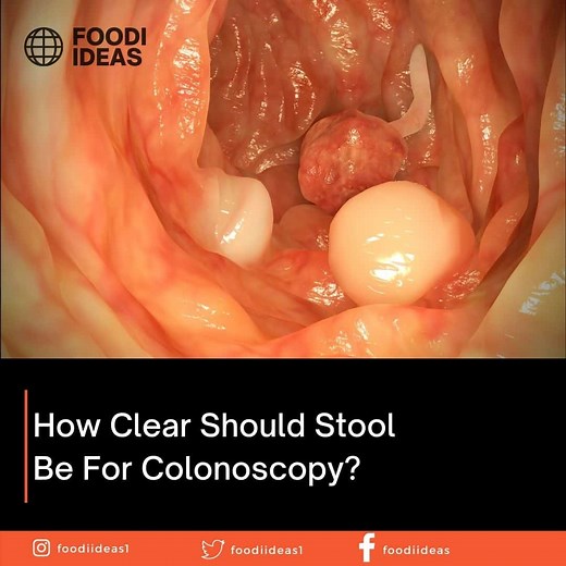 How Clear Should Stool Be For Colonoscopy?